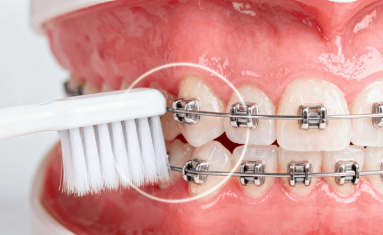 Daily Cleaning Habits For Orthodontic Success