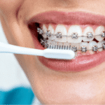 How to Maintain Oral Hygiene While Wearing Metal Braces in Surrey
