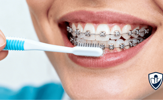 How to Maintain Oral Hygiene While Wearing Metal Braces in Surrey