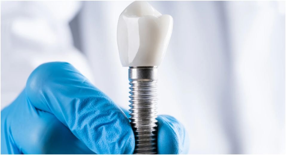 Importance of Choosing Skilled Dentists for Safe Dental Implant Procedures in Winnipeg