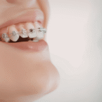 What Age Is Best for Getting Braces in Kelowna