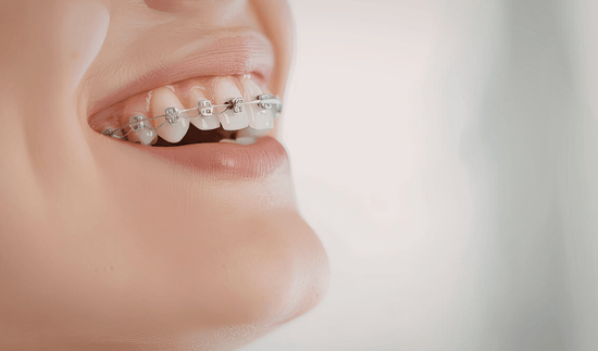 What Age Is Best for Getting Braces in Kelowna