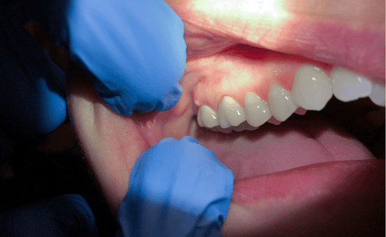 Broken or Cracked Tooth