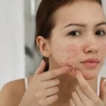 Why Your Acne Cleanser Might Be Making Your Breakouts Worse