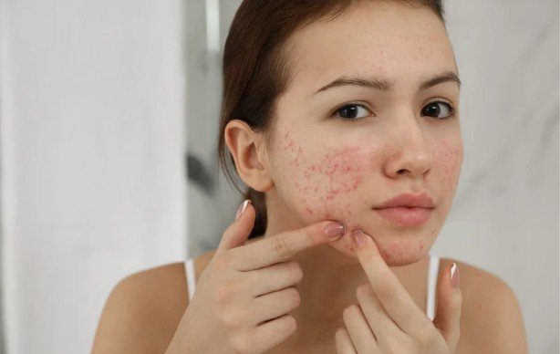 Why Your Acne Cleanser Might Be Making Your Breakouts Worse